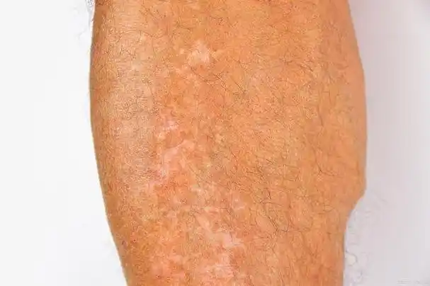 治疗白斑的有效方法有哪些?