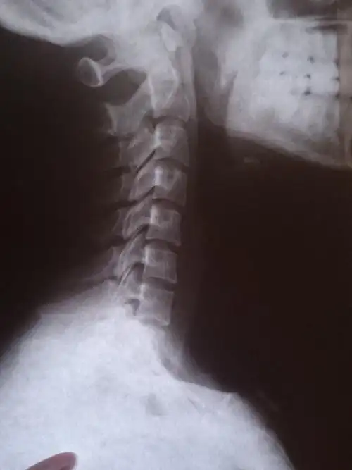 24岁颈椎骨质增生