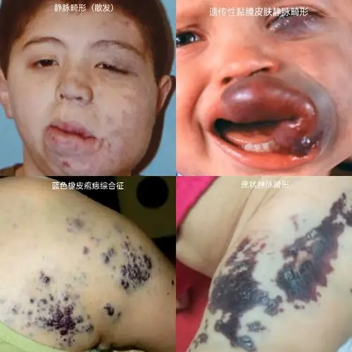 什么是静脉畸形?如何治疗?_血管瘤_介绍_治疗方式 - 好大夫在线