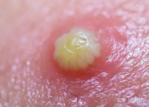 人身上被螨虫咬的图片是什么样的除螨虫效果最好的除螨皂排名