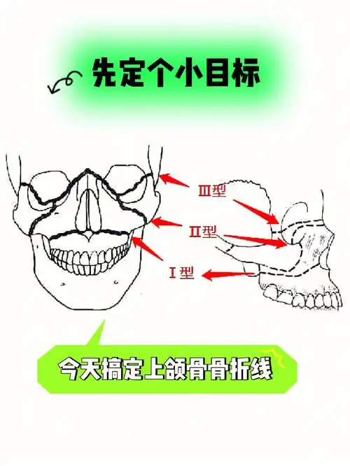 先定个小目标7575今天搞定上颌骨骨折线7575