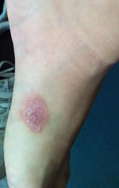 小心这些不痛不痒的皮肤病系列一梅毒