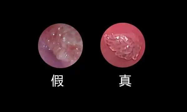 真假湿疣.jpg