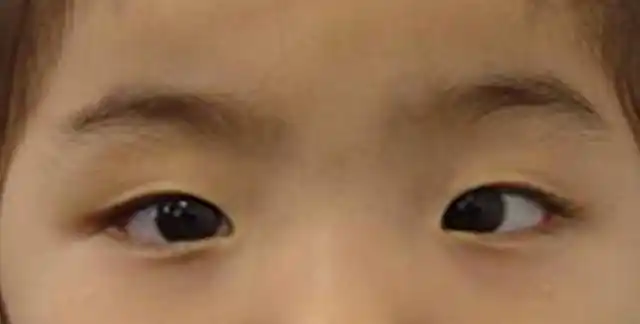 孩子眼珠挤到一起是对眼吗真假内斜视怎么分