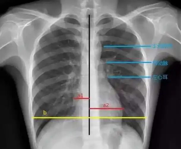 梨形心靴形心烧瓶心这也样看平片想不会都难