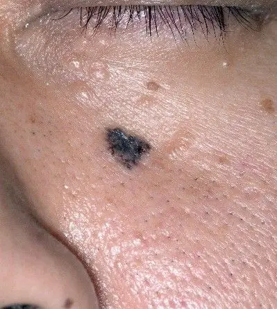 是癌不是痣——不能大意的"痦子"