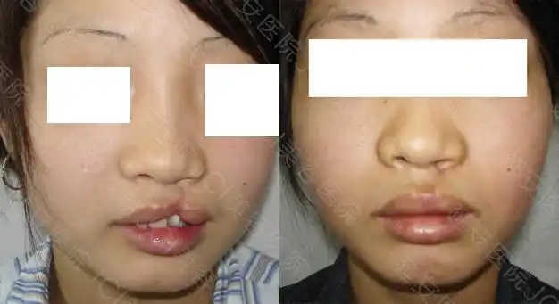 天生兔唇让我很自卑,这次做了修复手术,从侧面看完全恢复了