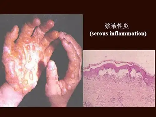 1,对症:抗生素消炎 局部换药;治疗:脓肿:慢性肉芽组织样及炎性假瘤