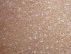 全面了解花斑糠疹病因与症状 做好相应防备避免严重疾患享健康