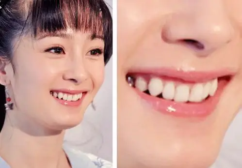 这些女星原来早就整过牙,而且无一例外那里都黑了?