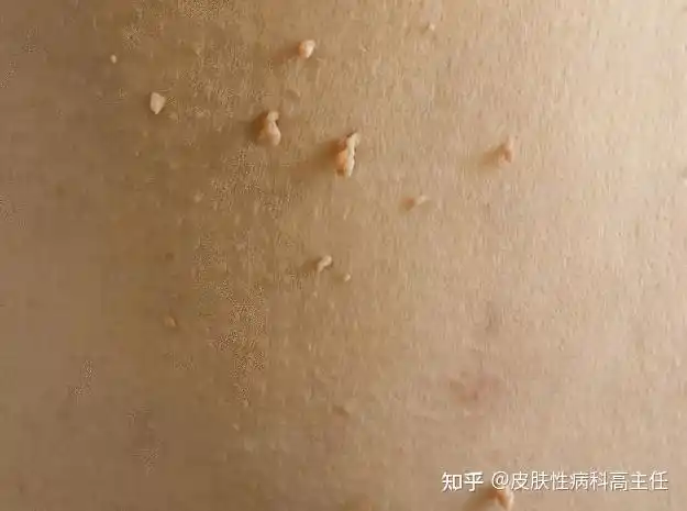 不要把丝状疣当做尖锐湿疣给自己造成困扰