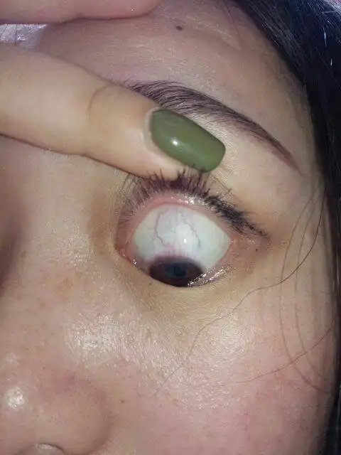 带隐形有个七八年了最近不知道怎么一带上隐形就要眼球发红有红血丝