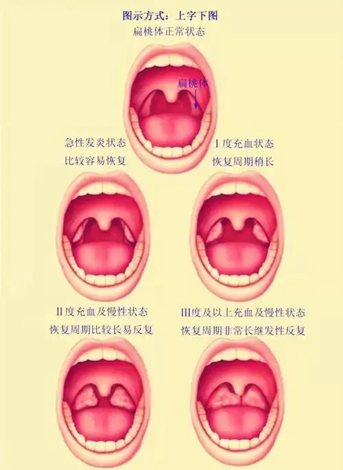 扁桃体经常惹是生非切除了就能一了百了不见得