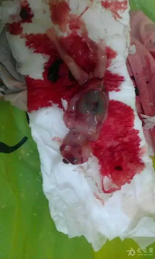 无脑儿有引产后图片