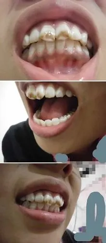 门牙歪 还很黄请问该怎么弄?