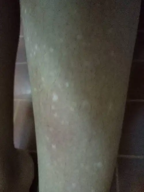 有快十年了.是汗斑吗?有什么治疗的方