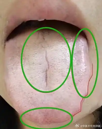 这个时候再进补,不堵才怪呢舌中裂纹,舌苔白腻——脾肾阳虚,痰湿严重