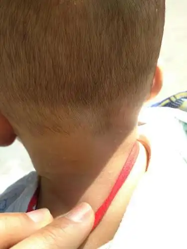 谁知道我宝宝脖子上长得这白色的点点是什么?求解