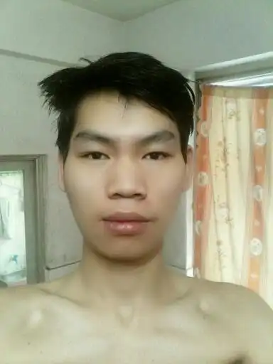 成畸形状态,正面看没有立体感,鼻梁下垂,侧面看鼻梁成驼峰鼻