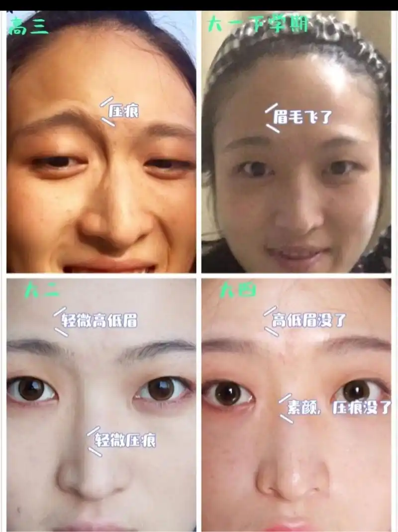 戴眼镜导致的眼睛变形怎么办,最全篇 没想到那么多人看上一篇,当初我