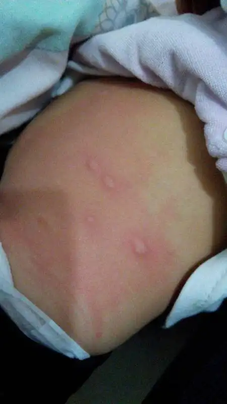 这是什么疙瘩～宝宝长在屁股上怎么办