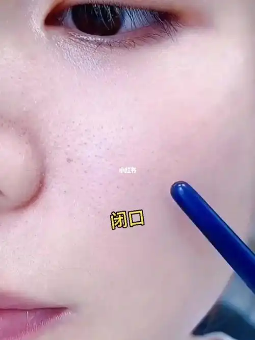 请大数据把它推给有黑头闭口粉刺的姐妹们