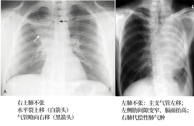 肺不张影像基本思路