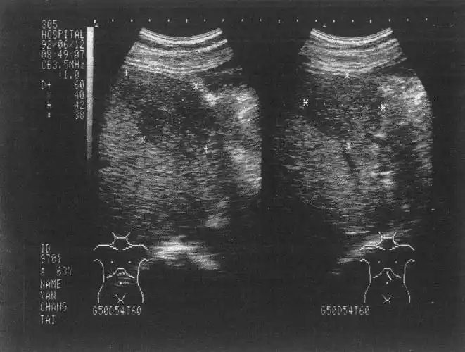 (图) 不均匀性脂肪肝声像图