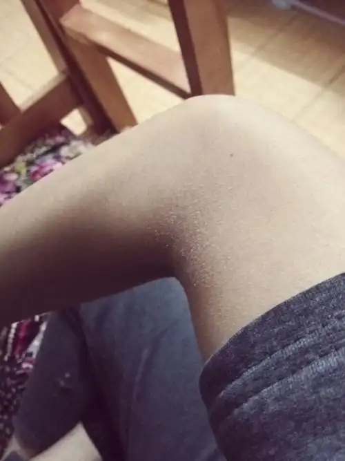 手肘外皮肤粗糙,手肘内也一样还掉皮,靠近肩膀的那段手臂皮肤也很粗