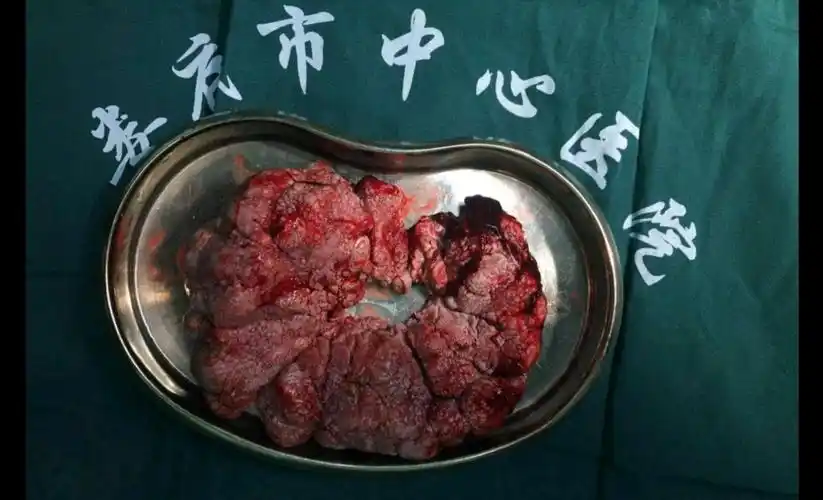 肛周长出巨大"菜花"?普外专家妙手"摘花"——市中心医院 - 好大夫在线