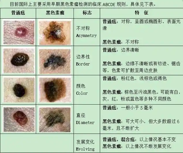 男歌手张恒远因患黑色素瘤去世,肿瘤专家教你"黑"白分明