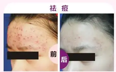 果酸换肤去痘印多少钱