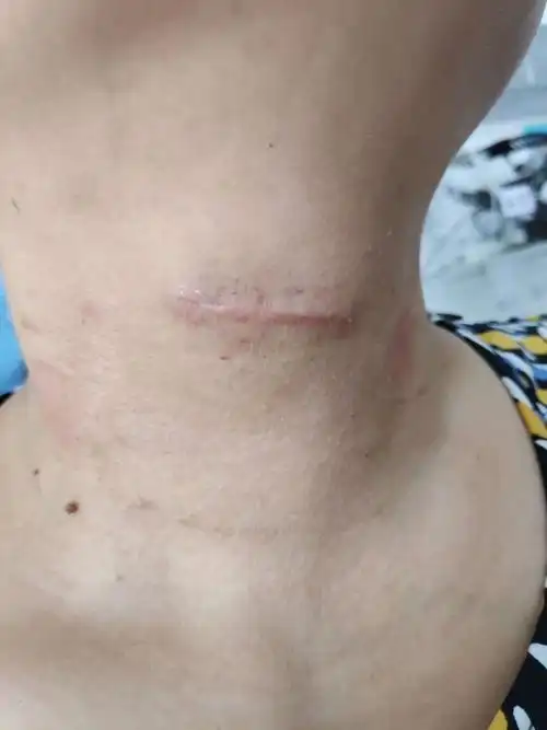 伤口的愈合过程 - 好大夫在线