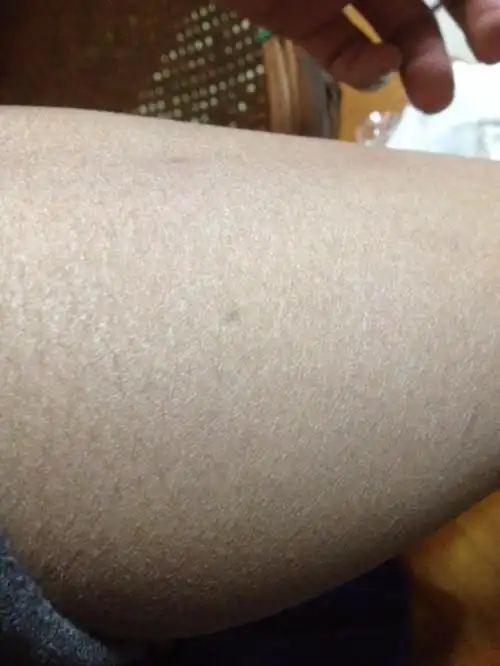 身体皮肤干怎么办全身皮肤干燥怎么办