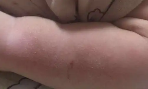 春季宝宝为什么会得干性湿疹?春季干性湿疹宝宝该怎么洗澡?