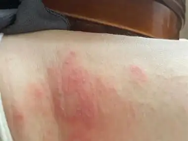 亚急性接触性皮炎的症状和图片 - 有来医生