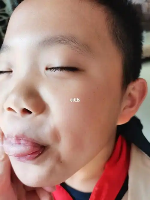 九岁的男孩子 今年忽然发现脸上这么多的雀斑 之前没有的 父母脸上都