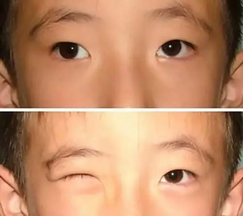 6岁前,这5种"眼病"最易被忽视,错过最佳治疗期