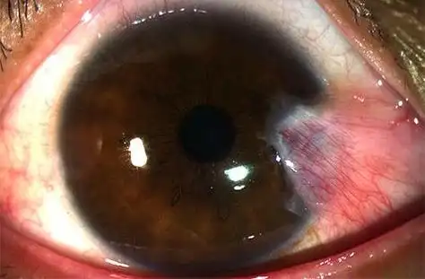 眼睛里面长了块肉,不痛不痒,要做手术切除吗?