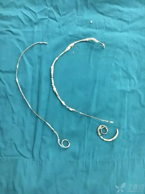 输尿管支架滞留怎么破 [病例帖]