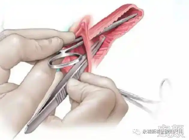 俗称阴道紧缩术,通过手术的方式,将盆底肌肉收紧,缩小阴道的宽度,让