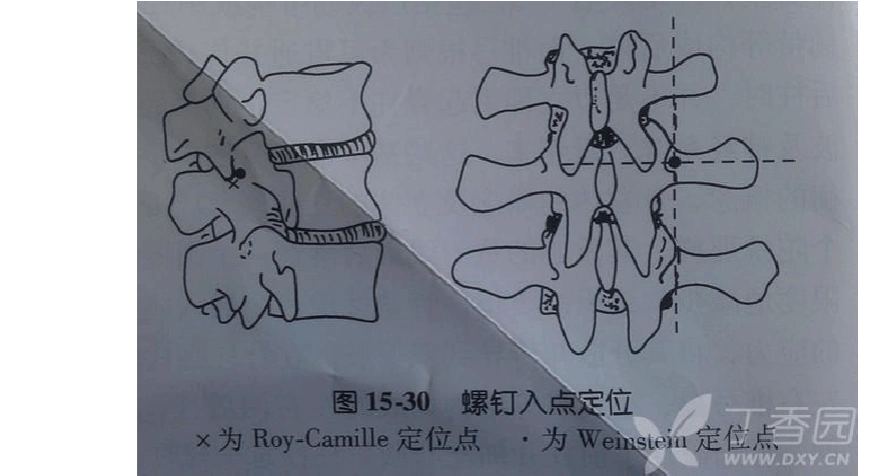 椎弓根螺钉置入图片