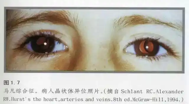 马凡氏综合症高个子要注意的天才病