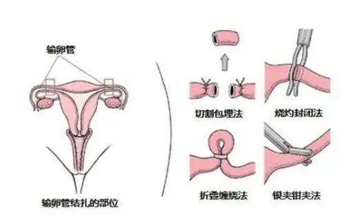 腹式输卵管结扎术