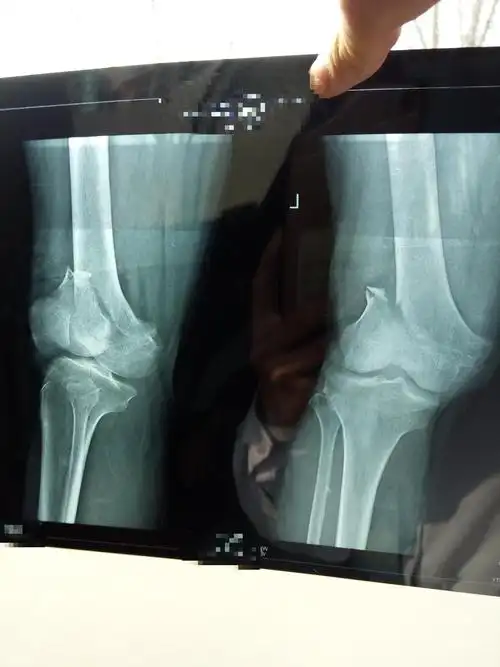 左股骨髁上骨折