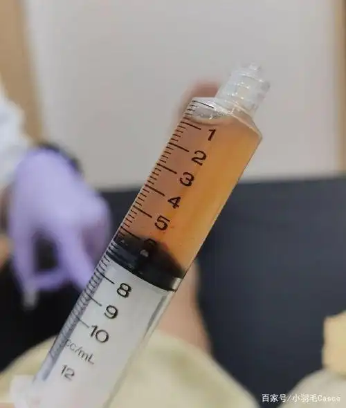 羽球名将吴柳莹晒抽积液照片,运动员艰辛只有自己知道