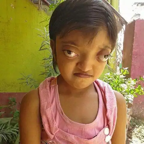 七岁女童古麻里(shaili kumari)因遗传病克鲁松氏症候群(crouzon