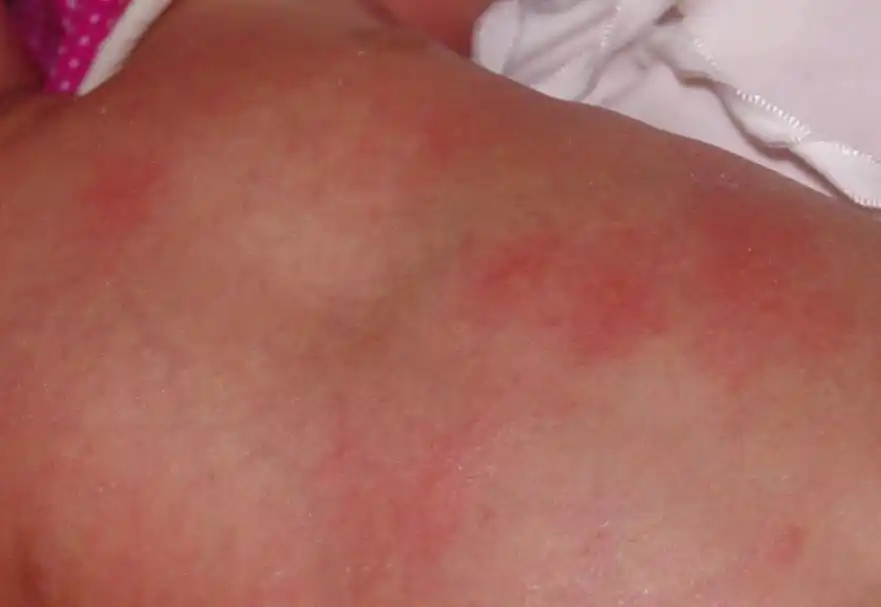 婴儿皮肤红斑,急!