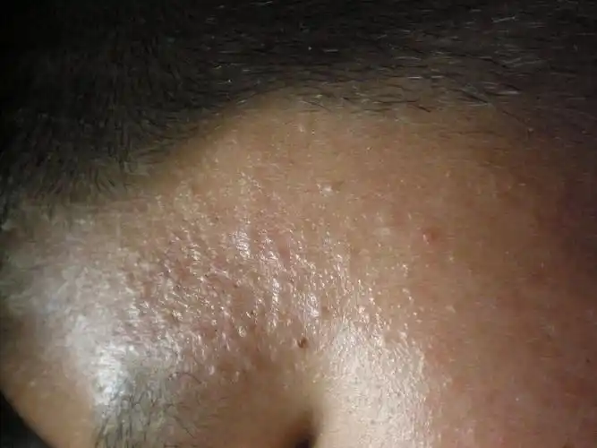 青少年油性皮肤起痘问题,求解答,,,,(附图)