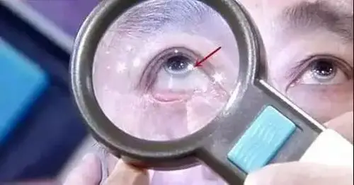 眼睛出现这8种症状可能是大病征兆有人治了几年才确诊